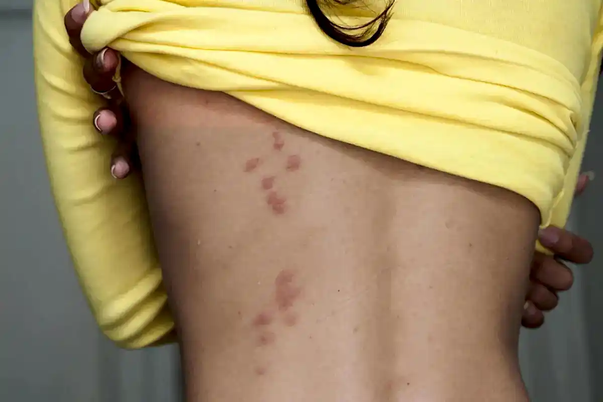 Tahta Kurusu Isırığı